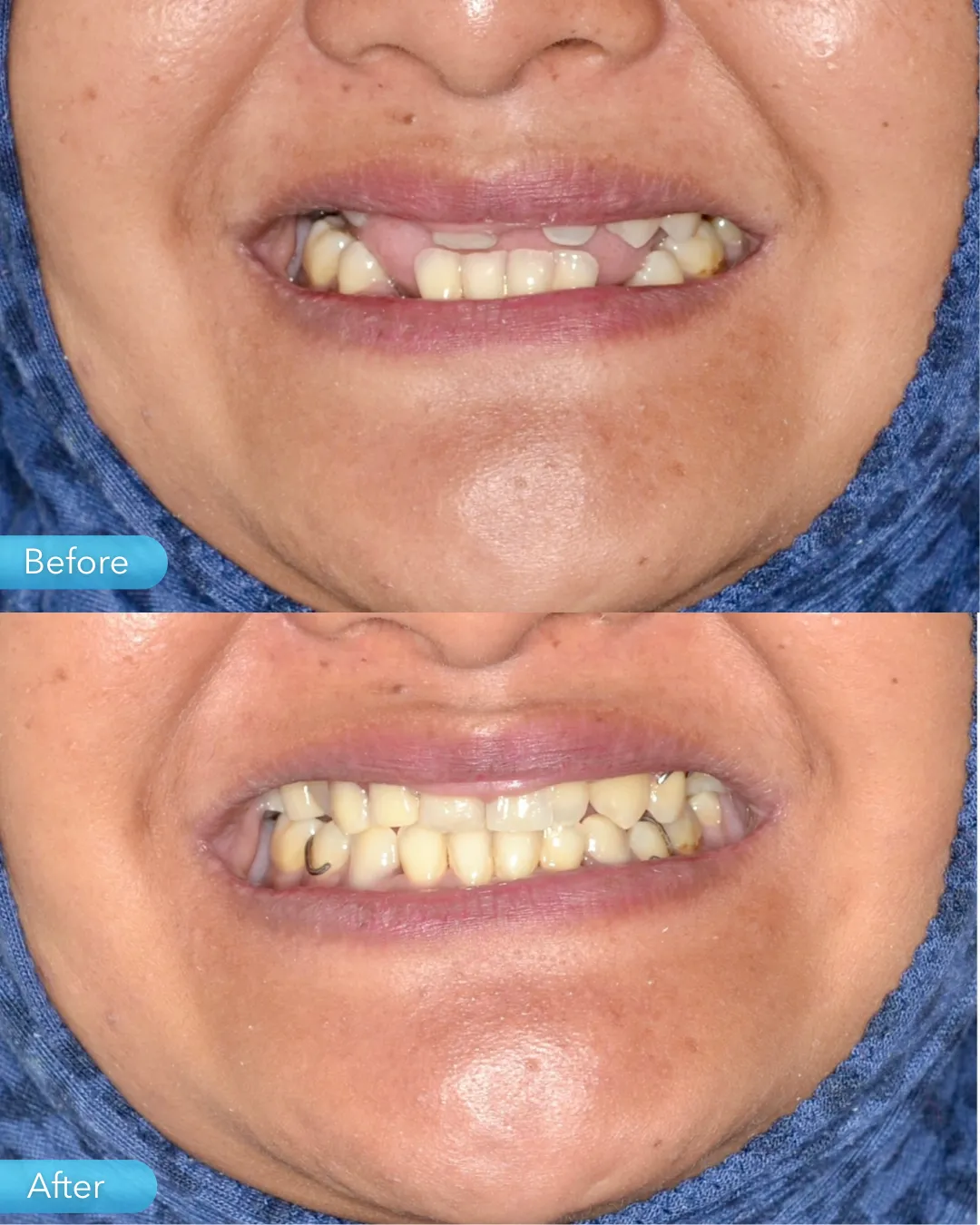 Gigi palsu result